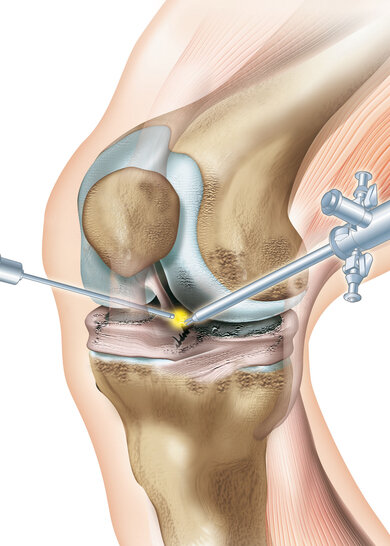 In den meisten Fällen, in denen ein Knie operiert werden muss, reicht eine Schlüsselloch-OP.