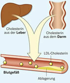 Cholesterin wird in der Leber gebildet oder aus dem Darm aufgenommen. Ezetimib hemmt die Aufnahme aus dem Darm