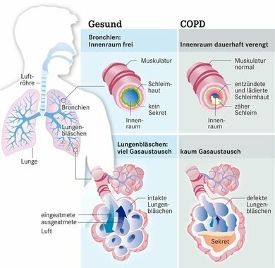 COPD: Bronchien in der Defensive