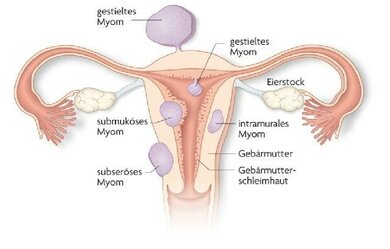 Myome der Gebärmutter: Verschiedene Formen und Lagen
