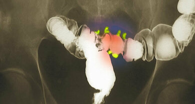 Dickdarmdivertikel im Röntgenbild (gelb-grüne Gebilde)