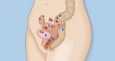 Endometriose: Fehlgeleitete Gebärmutterschleimhaut. 1 Gebärmutterwand (außen), 2 Eierstock, 3 Scheide, 4 Darm, 5 Blase