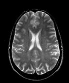 MRT-Querschnitt des Gehirns. Die hellen Bereiche sind flüssigkeitsgefüllte Hohlräume
