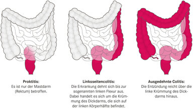 Schweregrade der Colitis ulcerosa: Proktitis (links), Linksseitencolitis (Mitte), ausgedehnte Colitis (rechts)