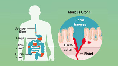 Bei Morbus Crohn entstehen Entzündungen in Dick- und Dünndarm, oft sogar im ganzen Verdauungstrakt. So können sich Verengungen (Stenosen) und  Verbindungsgänge (Fisteln) bilden.