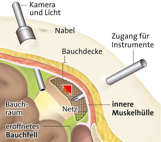 Leistenbruch Leistenhernie Apotheken Umschau