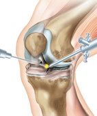 Schlüsselloch-Operation am Knie: Ärzte reparieren gerissene Bänder meist im Rahmen einer Gelenkspiegelung (Arthroskopie)