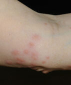 Punkte am oberschenkel rote Hautkrankheiten erkennen