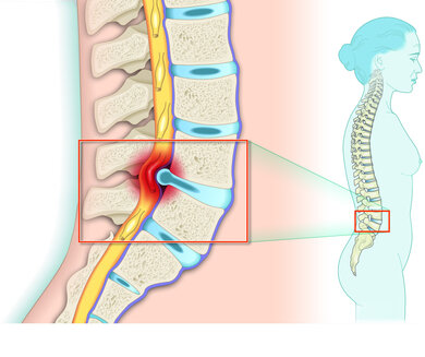 Bei einem Bandscheibenvorfall drückt der Bandscheibenkern auf den Rückenmarksnerv. Bildgebende Verfahren wie Röntgen, CT oder MRT machen das für den Arzt sichtbar