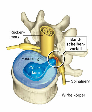 Bandscheibenvorfall: Der Bandscheibenkern durchbricht den eingerissenen Faserring und kann den Rückenmarksnerv beengen
