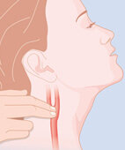 Karotis-Sinus-Druckversuch (schematisch; Halsschlagader zum besseren Verständnis hervorgehoben)