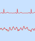 Kammerflimmern im EKG (untere Linie)