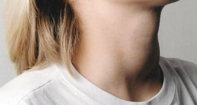 Kropf vorne am Hals: Die vergrößerte Schilddrüse kann zur Überfunktion führen