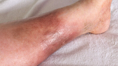 Schmerzhaft: Ein Erysipel (eine Wundrose) entsteht oft am Bein