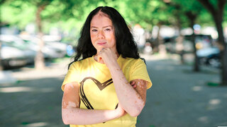 Die Weißfleckenkrankheit (Vitiligo) macht sich mit hellen, pigmentarmen oder pigmentfreien Stellen auf der Haut bemerkbar