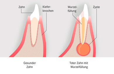 Entzünden sich Nerven und Blutgefäße eines Zahns, ist eine Wurzelkanalbehandlung mit anschließender Wurzelfüllung nötig. An der Wurzelspitze toter Zähne kann sich eine Zyste bilden.