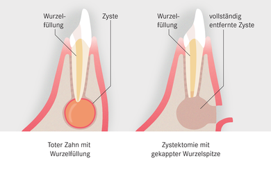 Zahnfleisch und Knochen werden eröffnet, um die Zyste zu entfernen. Danach bleibt ein Hohlraum unter dem Zahnfleisch zurück, der mit der Zeit verknöchert.