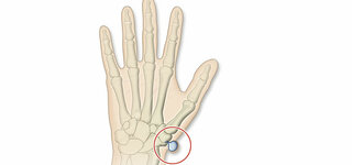 Handgelenk knubbel im Ganglion (Überbein):