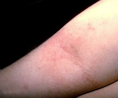 Neurodermitis: Trockene Haut und geröteter Hautausschlag &#x96; hier an der Ellbeuge