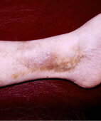 Eine Folge chronischer Venenschwäche: Braun verfärbte Hautstellen an den Knöcheln