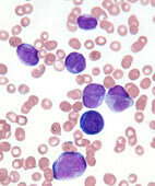 Blutausstrich mit Leukämiezellen (violett) und roten Blutkörperchen (rosafarben)