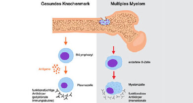Beim Multiplen Myelom entartet eine Plasmazelle (B-Zell-Lymphozyt)
