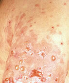 Bullöses Pemphigoid an Oberarm und Oberkörper: Juckende Blasen, Rötungen und Schwellungen sind typische Symptome