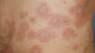 Vermehrt Lichtempfindliche Haut Ursachen Und Hilfen Apotheken Umschau
