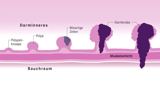 Darmpolypen: Ursachen, Risiken, Behandlung | Apotheken-Umschau