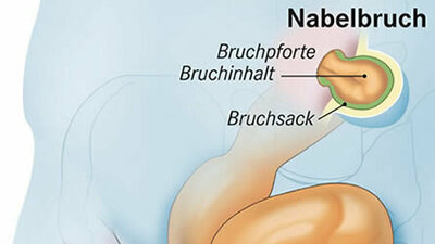 Nabelbruch (Schematische Darstellung)