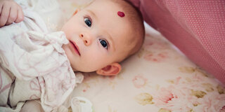 Hinter einem roten Fleck kann ein Blutschwämmchen - ein infantiles Hämangiom - stecken. Es betrifft vor allem Babys. Meistens ist es harmlos.