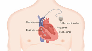 Der Herzschrittmacher wird oft unterhalb des Schlüsselbeins eingesetzt. Die Elektroden liegen im Herzen.