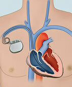 Der Herzschrittmacher kann unter dem rechten oder linken Schlüsselbein platziert werden