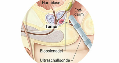 Bei der Prostata wird über den Darm mit Ultraschallkontrolle eine Stanzbiospie entnommen.