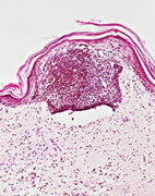 So sieht ein bösartiger Hauttumor (Basaliom) unter dem Mikroskop aus
