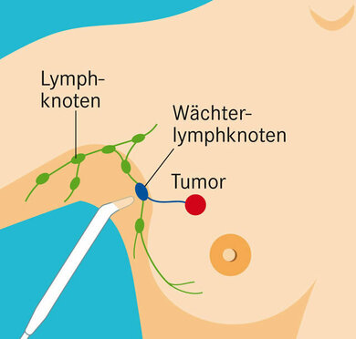 Oft per Biopsie untersucht: Der "Wächterlymphknoten" bei Brustkrebs
