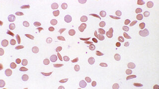 Blutausstrich bei Sichelzellenanämie