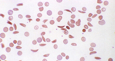 Auf dem Blutausstrich ist die Sichelform einiger Blutkörperchen gut zu erkennen