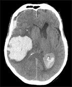 Im Schädel-CT dargestellte große intrazerebrale Blutung (weiß)