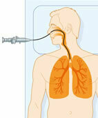Bei einer Lungenspiegelung gewinnt der Arzt Spülflüssigkeit aus den Bronchien. Sie kann auf MERS-CoV untersucht werden