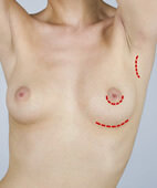 Der Hautschnitt kann in der Achsel, am Rand der Brustwarze oder in der Falte unter der Brust erfolgen
