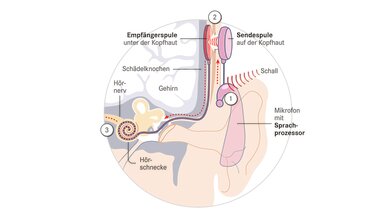 1. Hinter dem Ohr empfängt ein Mikrofon den Schall, ein Sprachprozessor wandelt ihn in digitale Signale um. Ein Kabel führt zur Sendespule.
2. Die Sendespule über der Kopfhaut überträgt die Signale an die Empfängerspule unter der Kopfhaut. Diese gibt die Signale über Elektroden weiter.
3. Einzelne Elektroden reizen die Hörnervfasern in der Hörschnecke. Der Hörnerv leitet diese Erregung ins Gehirn.
