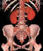 CT-Angiografie: 3D-Darstellung der Becken- und Bauchgefäße samt Skelett