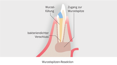 Die Kappung der Wurzelspitze ist der letzte Versuch, eine Entzündung am Zahn zu stoppen. Andernfalls muss er gezogen werden.
