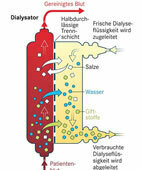 Bei der Dialyse werden Giftstoffe, Wasser und Salze entsorgt