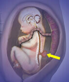 Spina bifida  (&#x84;offener Rücken&#x93;) beim Ungeborenen: Rückenmarksgewebe und Hirnhäute sind sackartig vorgewölbt (gelber Pfeil)