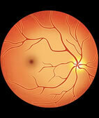Augenhintergrund: Die Eintrittsstelle des Sehnerven an der Papille (hellgelb) sieht bei einer typischen Sehnervenentzündung ganz normal aus