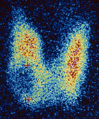 Szintigramm der Schilddrüse mit einem kalten Knoten (blau, links unten im Bild)