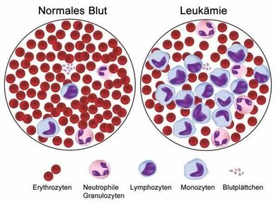 Eine Leukämie geht mit Veränderungen im Blutbild einher