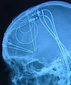 Das Röntgenbild zeigt die Lage der THS-Elektroden